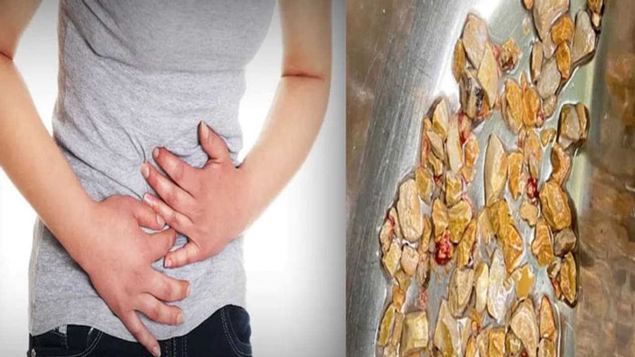 एक दो नहीं इस शख्स की किडनी से निकाली गई 206 पथरी, जानें Kidney Stone के लक्षण और बचाव एक दो नहीं इस शख्स की किडनी से निकाली गई 206 पथरी, जानें Kidney Stone के लक्षण और बचाव