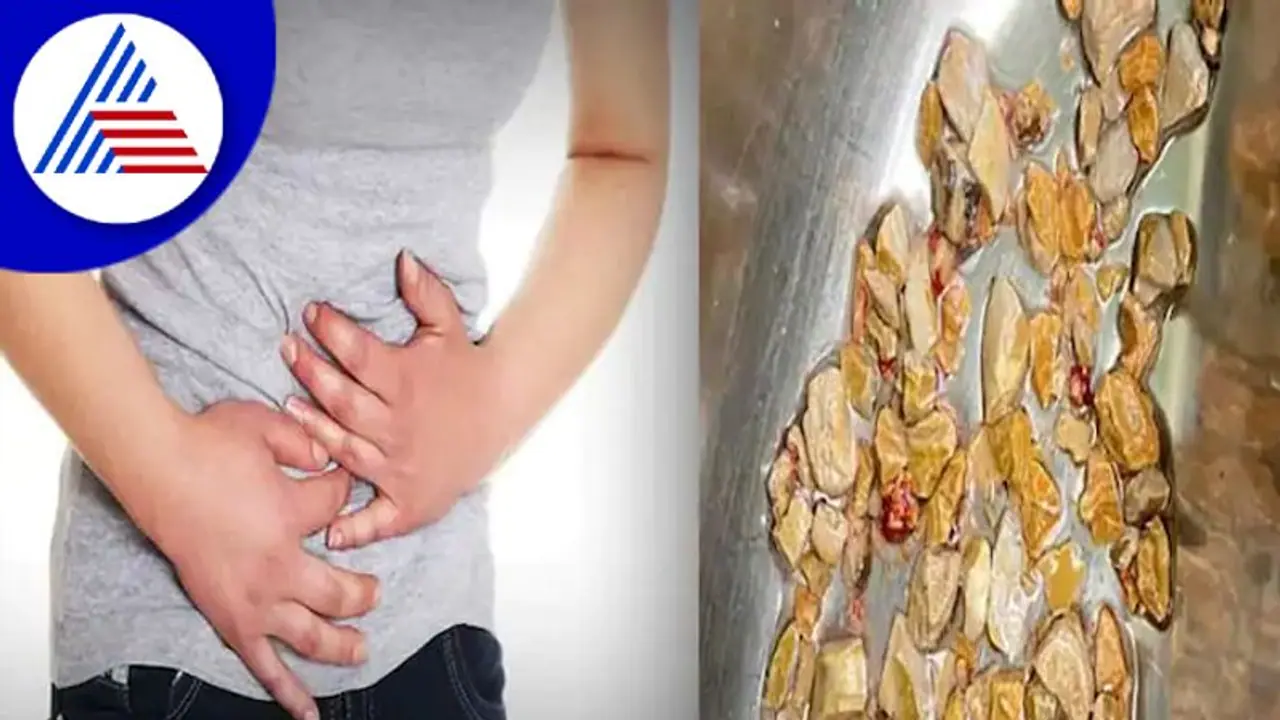 ಒಂದಲ್ಲ..ಎರಡಲ್ಲ, ವ್ಯಕ್ತಿಯ ದೇಹದಿಂದ ಬರೋಬ್ಬರಿ 206 ಕಿಡ್ನಿ ಸ್ಟೋನ್‌ ಹೊರತೆಗೆದ ವೈದ್ಯರು !