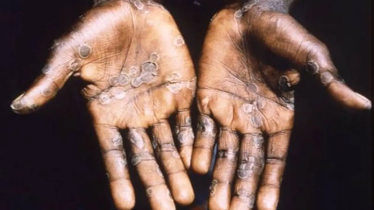 Antiviral medications likely to reduce symptoms of Monkeypox, suggests Lancet study