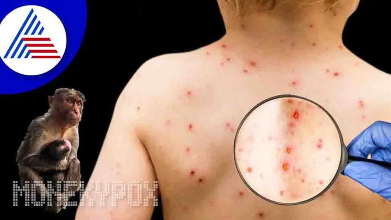 ಮಕ್ಕಳಿಗೆ ಮಂಕಿಪಾಕ್ಸ್ ಸೋಂಕು ಹರಡದಂತೆ ಎಚ್ಚರಿಕೆ ವಹಿಸುವುದು ಹೇಗೆ ? ಮಕ್ಕಳಿಗೆ ಮಂಕಿಪಾಕ್ಸ್ ಸೋಂಕು ಹರಡದಂತೆ ಎಚ್ಚರಿಕೆ ವಹಿಸುವುದು ಹೇಗೆ ?