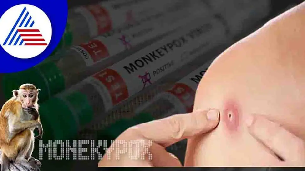 ಗಾಳಿಯಲ್ಲೂ ಹರಡುತ್ತಂತೆ ಮಂಕಿಪಾಕ್ಸ್ ವೈರಸ್‌, ಮಾಸ್ಕ್ ಹಾಕಿಕೊಳ್ಳುವಂತೆ ತಜ್ಞರ ಸಲಹೆ 