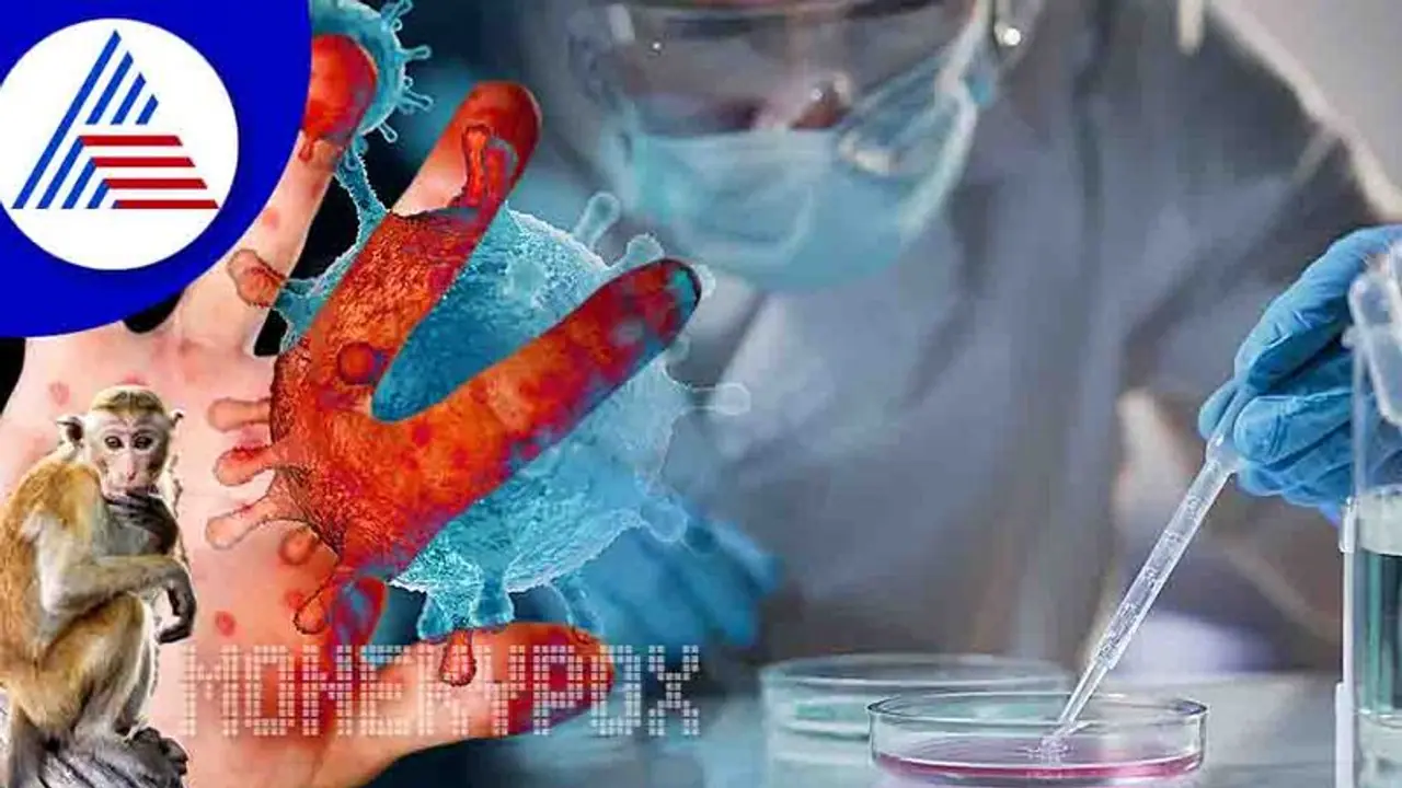 ಮಂಕಿಪಾಕ್ಸ್ v/s ಚಿಕನ್ ಪಾಕ್ಸ್: ಎರಡೂ ಸೋಂಕಿನ ಮಧ್ಯೆ ವ್ಯತ್ಯಾಸ ತಿಳಿದುಕೊಳ್ಳುವುದು ಹೇಗೆ ?