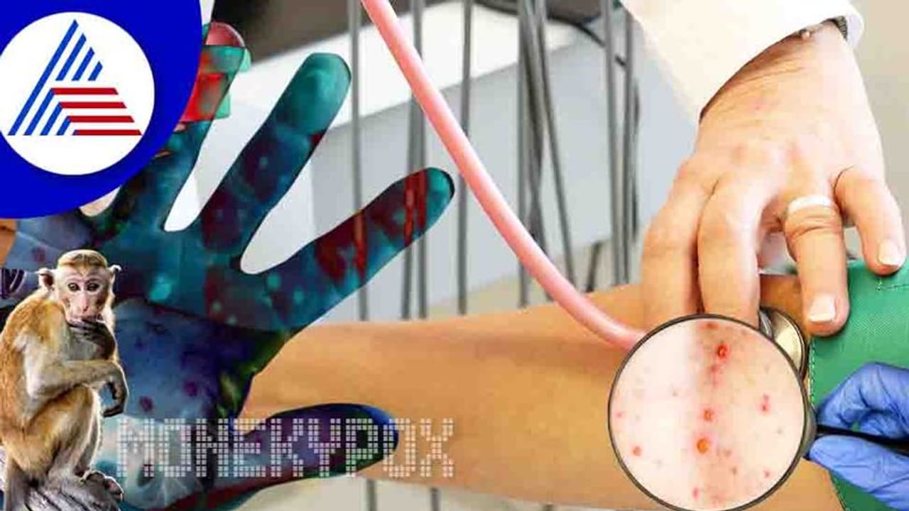 Monkeypox Alert: ಪ್ರಪಂಚದಾದ್ಯಂತ 50,000ಕ್ಕೂ ಹೆಚ್ಚು ಪ್ರಕರಣ ದಾಖಲು Monkeypox Alert: ಪ್ರಪಂಚದಾದ್ಯಂತ 50,000ಕ್ಕೂ ಹೆಚ್ಚು ಪ್ರಕರಣ ದಾಖಲು