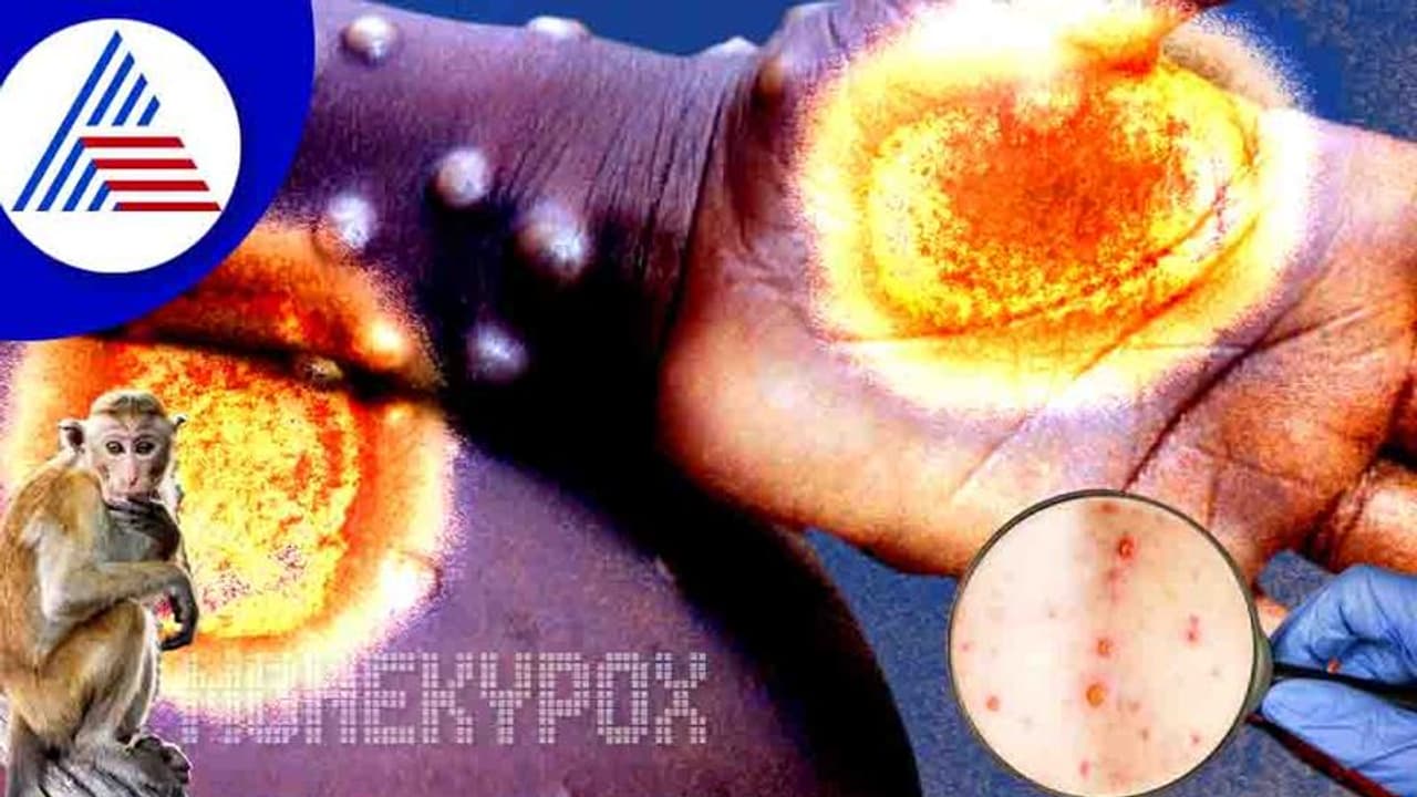 ಮಂಕಿಪಾಕ್ಸ್‌ ಸೋಂಕಿನ ಬಗ್ಗೆ ನೀವಂದುಕೊಂಡಿರೋ ಈ ವಿಚಾರವೆಲ್ಲಾ ನಿಜವಲ್ಲ !