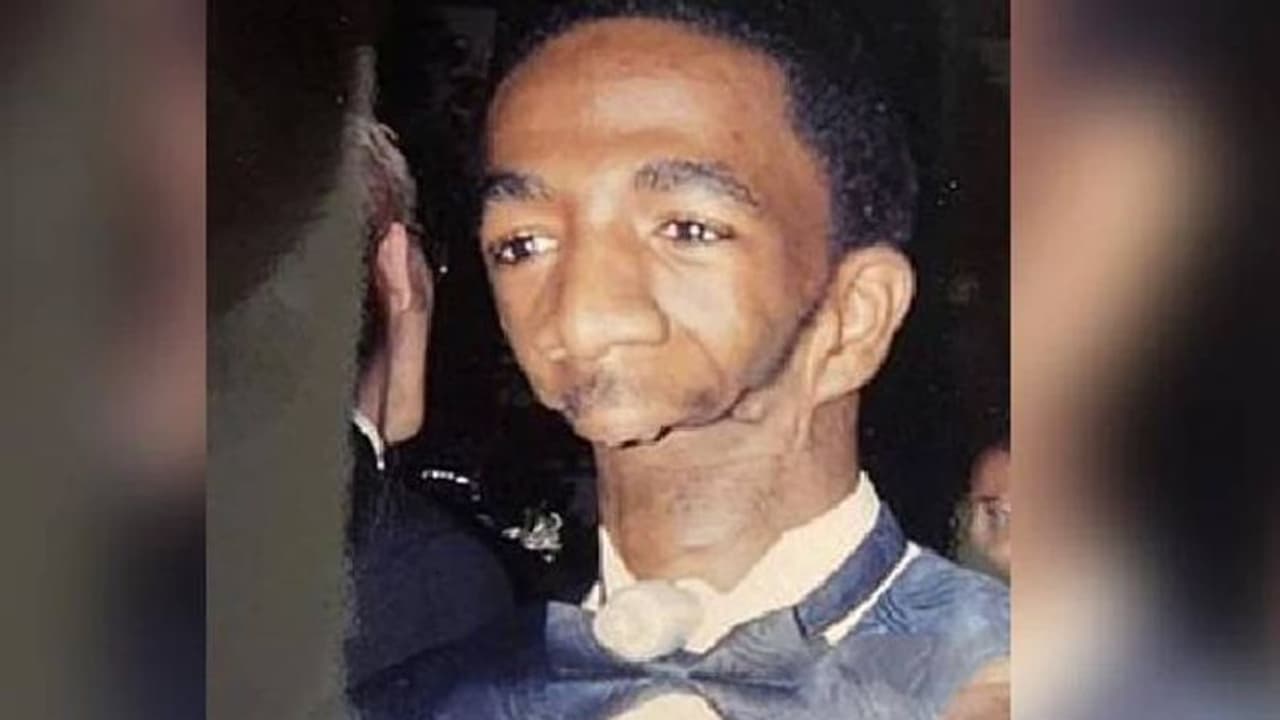 താടിയെല്ലില്ലാത്ത അപൂർവാവസ്ഥ, ഭക്ഷണം കഴിക്കാനോ സംസാരിക്കാനോ ആവില്ല, പരിഹസിച്ചവർക്ക് മുന്നിൽ ജീവിച്ച് ജോസഫ്