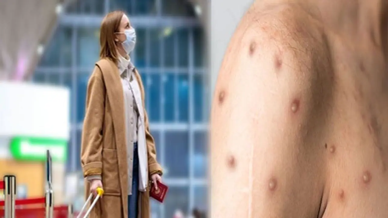 मंकीपॉक्स का बढ़ रहा है खतरा, विदेश में यात्रा करने से भले ध्यान रखें ये जरूरी बातें