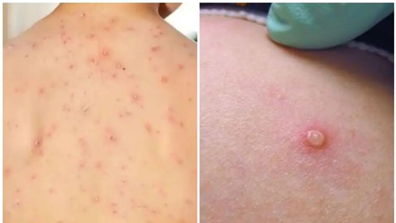 Monkeypox : മങ്കിപോക്സ് ; അവഗണിക്കരുത്, കുട്ടികളിൽ കാണുന്ന പ്രാരംഭ ലക്ഷണങ്ങൾ Monkeypox : മങ്കിപോക്സ് ; അവഗണിക്കരുത്, കുട്ടികളിൽ കാണുന്ന പ്രാരംഭ ലക്ഷണങ്ങൾ