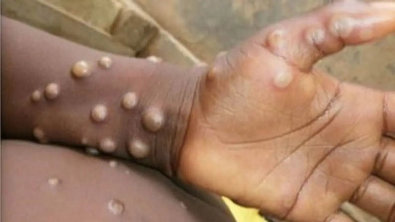Avoid sharing towels, wash hands and more: Health Ministry releases dos, don'ts to prevent spread of Monkeypox