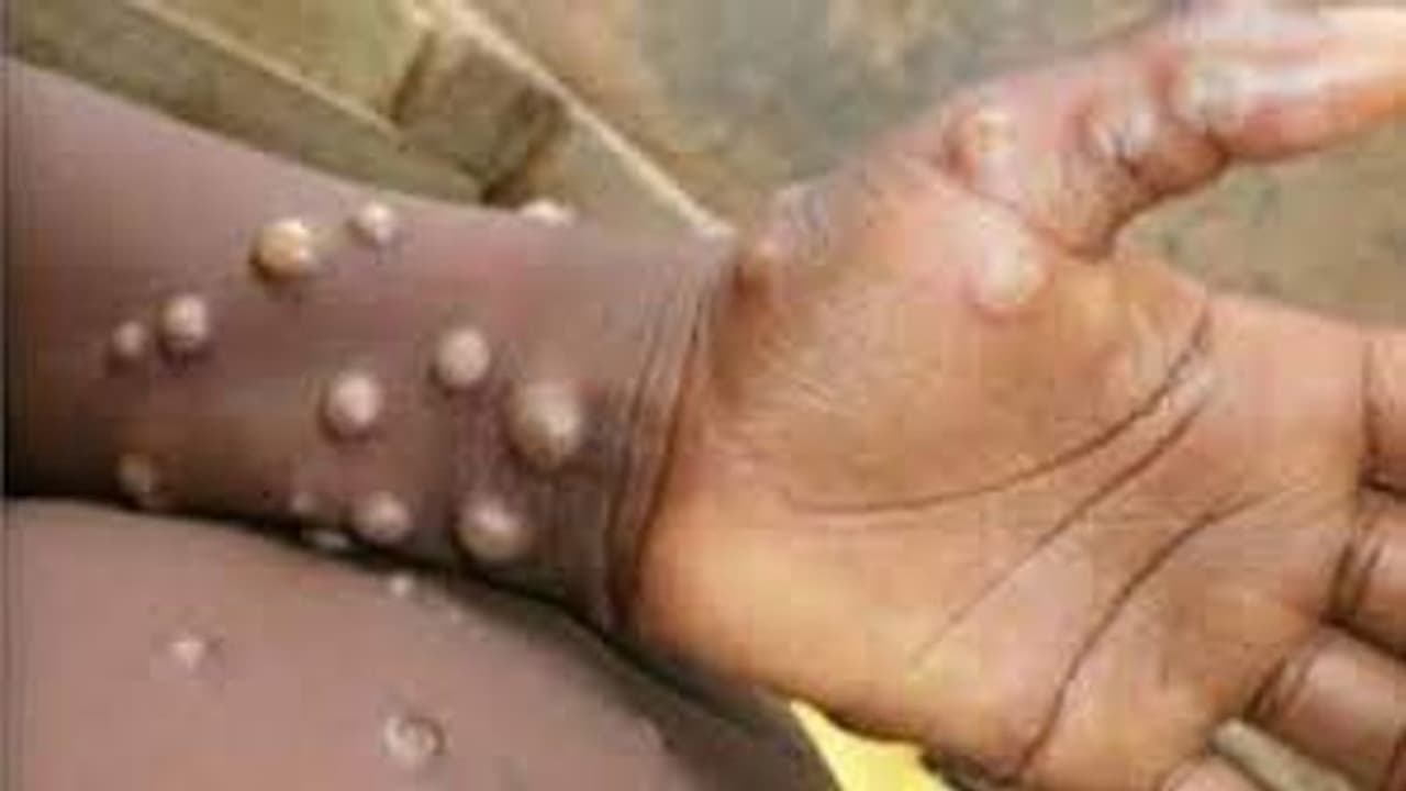 India's first Monkeypox case confirmed, Centre steps up surveillance; know about all about virus