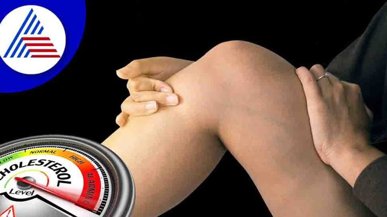 ಕಾಲಲ್ಲೂ ಕಾಣಿಸಿಕೊಳ್ಳುತ್ತೆ ಕೊಲೆಸ್ಟ್ರಾಲ್ ಸೂಚನೆ, ರೋಗಲಕ್ಷಣಗಳ ಬಗ್ಗೆ ಗೊತ್ತಿರಲಿ ಕಾಲಲ್ಲೂ ಕಾಣಿಸಿಕೊಳ್ಳುತ್ತೆ ಕೊಲೆಸ್ಟ್ರಾಲ್ ಸೂಚನೆ, ರೋಗಲಕ್ಷಣಗಳ ಬಗ್ಗೆ ಗೊತ್ತಿರಲಿ
