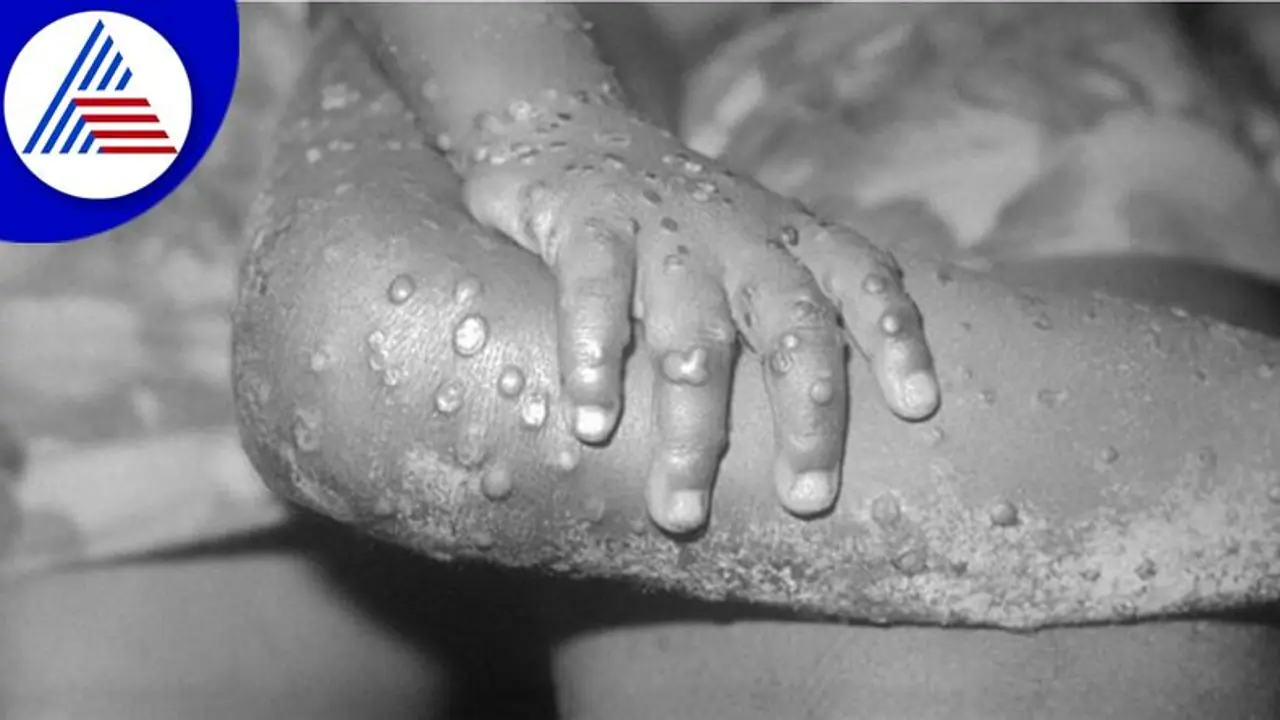 ಭಾರತದ 2 ನೇ ಎಂಪಾಕ್ಸ್ ಕೇಸ್‌: ಕೇರಳದಲ್ಲಿ 38 ವರ್ಷದ ವ್ಯಕ್ತಿಗೆ ಮಂಕಿಪಾಕ್ಸ್ ಸೋಂಕು ದೃಢ!