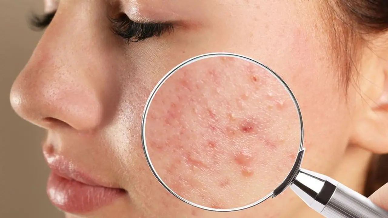 Worst Foods for Acne : മുഖക്കുരു അലട്ടുന്നുണ്ടോ? ഭക്ഷണത്തിൽ ശ്രദ്ധിക്കേണ്ടത്...