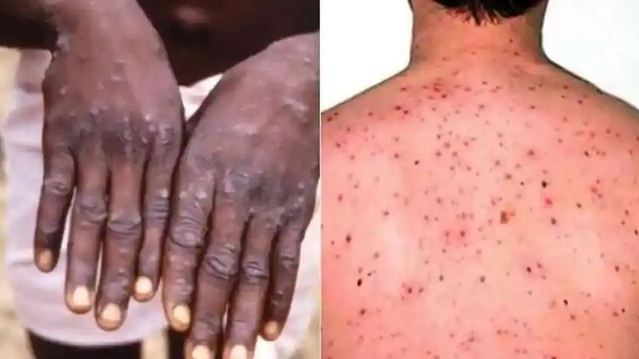 Monkeypox: WHO releases five critical measures to prevent the spread of infection 