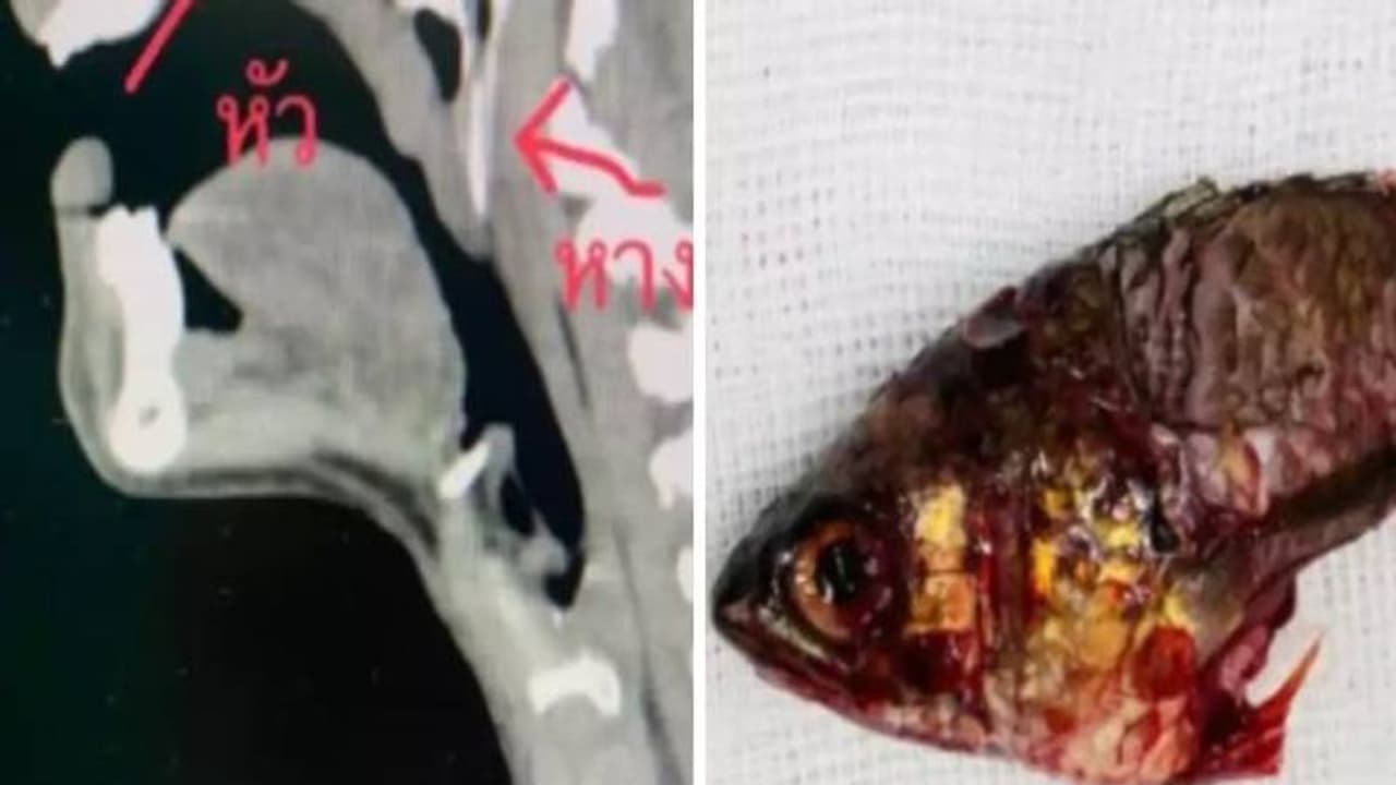 മീൻ നേരെ ചാടിയത് മത്സ്യത്തൊഴിലാളിയുടെ തൊണ്ടയിലേക്ക്, പുറത്തെടുക്കാൻ ഒരു മണിക്കൂർ ശസ്ത്രക്രിയ!