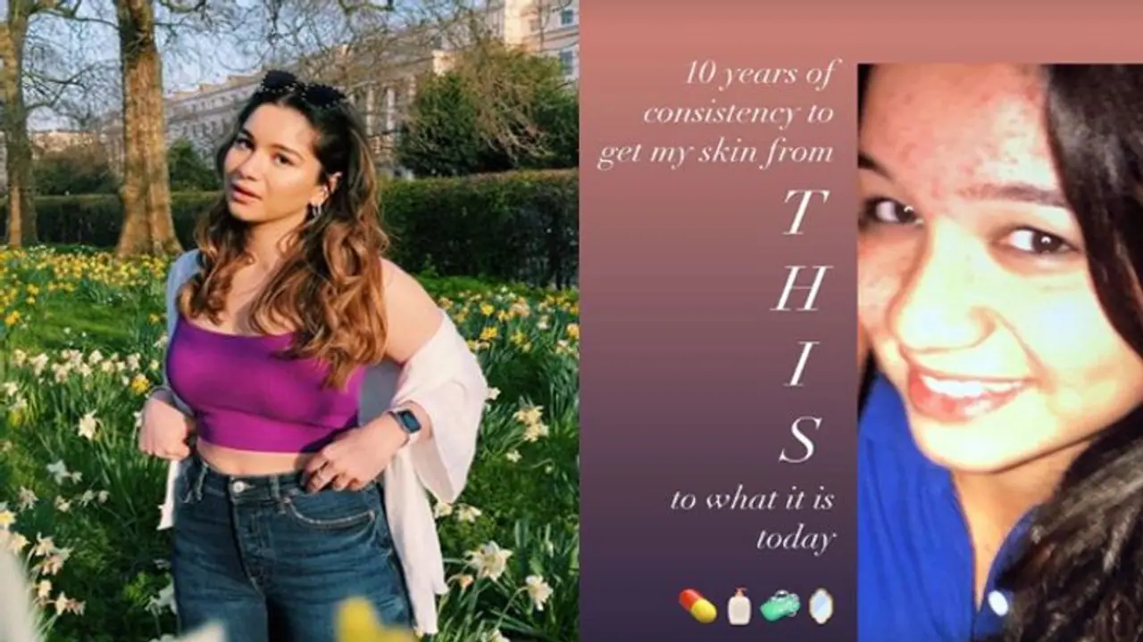 क्या है सचिन की लाडली सारा की खूबसूरती का राज? 10 साल पहले पिंपल्स से भरा था पूरा चेहरा क्या है सचिन की लाडली सारा की खूबसूरती का राज? 10 साल पहले पिंपल्स से भरा था पूरा चेहरा