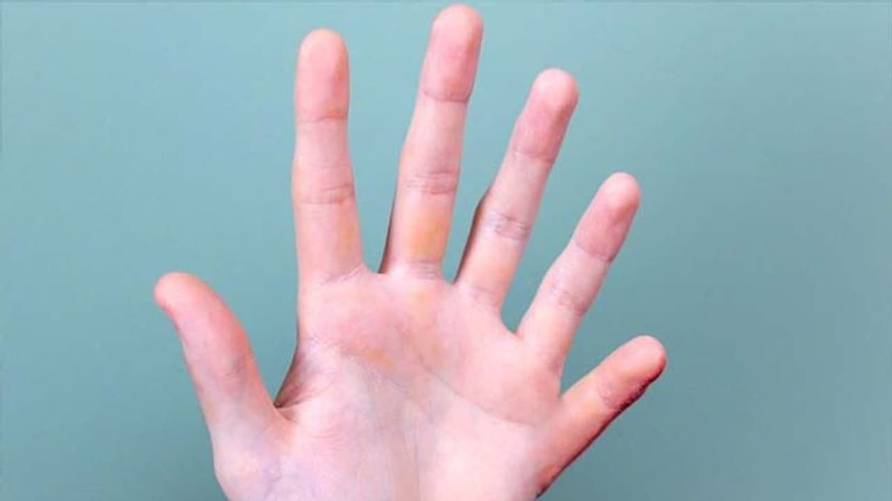 किस्मत के धनी होते हैं वे लोग जिनके हाथों में होती हैं 6 उंगली, ये हर काम करते हैं अलग तरीके से किस्मत के धनी होते हैं वे लोग जिनके हाथों में होती हैं 6 उंगली, ये हर काम करते हैं अलग तरीके से