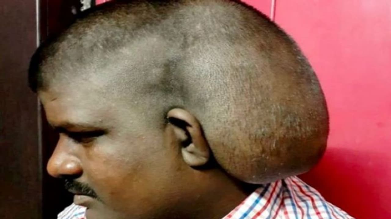 चीजें रखकर भूल गए, बोलने सुनने में हो रही परेशानी, चेहरा पड़ रहा सुन्न बदल रहा रंग तो फौरन जाइए डॉक्टर के पास