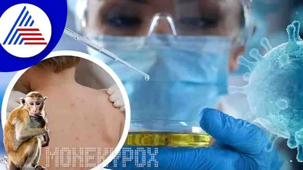 ಬೆಂಗಳೂರಿಗರಿಗೆ ರಿಲೀಫ್‌, ಇಥಿಯೋಪಿಯಾದಿಂದ ಬಂದಿದ್ದ ವ್ಯಕ್ತಿಯ ಮಂಕಿಪಾಕ್ಸ್ ವರದಿ ನೆಗೆಟಿವ್‌