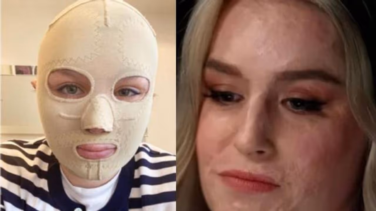 അഗ്നിപർവ്വത സ്‌ഫോടനത്തിൽ ഗുരുതരമായി പൊള്ളലേറ്റു, മാസ്ക് മാറ്റി ലോകത്തിന് മുന്നിൽ മുഖം വെളിപ്പെടുത്തി യുവതി