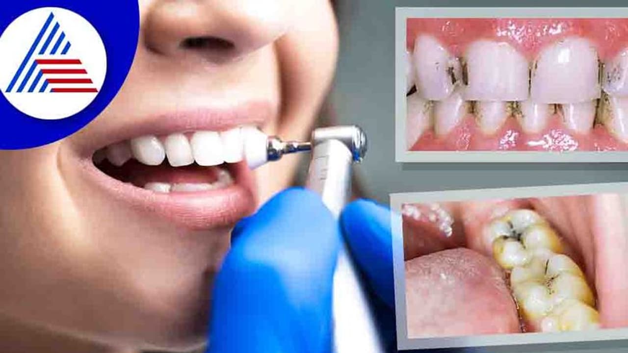 ಹಲ್ಲಿನ ಅಂದ ಕೆಡಿಸುವ 'ಪಾಚಿ'ಗೆ ಪರಿಹಾರ ನಮ್ಮಲ್ಲೇ ಇದೆ!