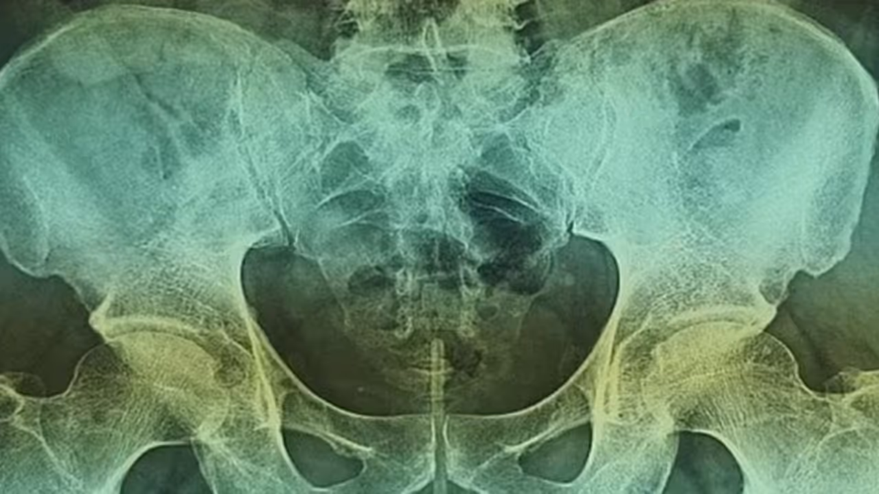 മൂത്രതടസ്സവുമായി ആശുപത്രിയില്‍ എത്തിയ ആളുടെ ലിംഗത്തിനുള്ളില്‍ വയര്‍!