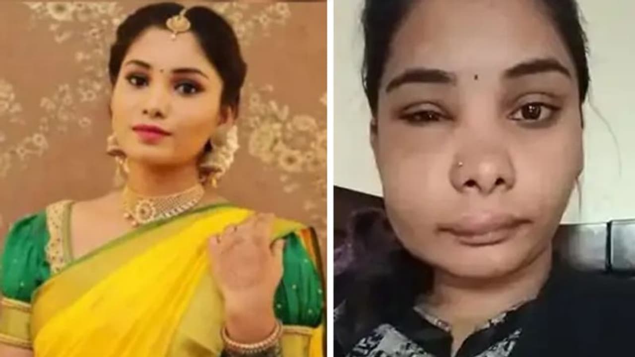 रूट कैनाल सर्जरी से एक्ट्रेस का बिगड़ा चेहरा,जानें क्या होता Root canal, ट्रीटमेंट से पहले रखें जरूरी सावधानी 