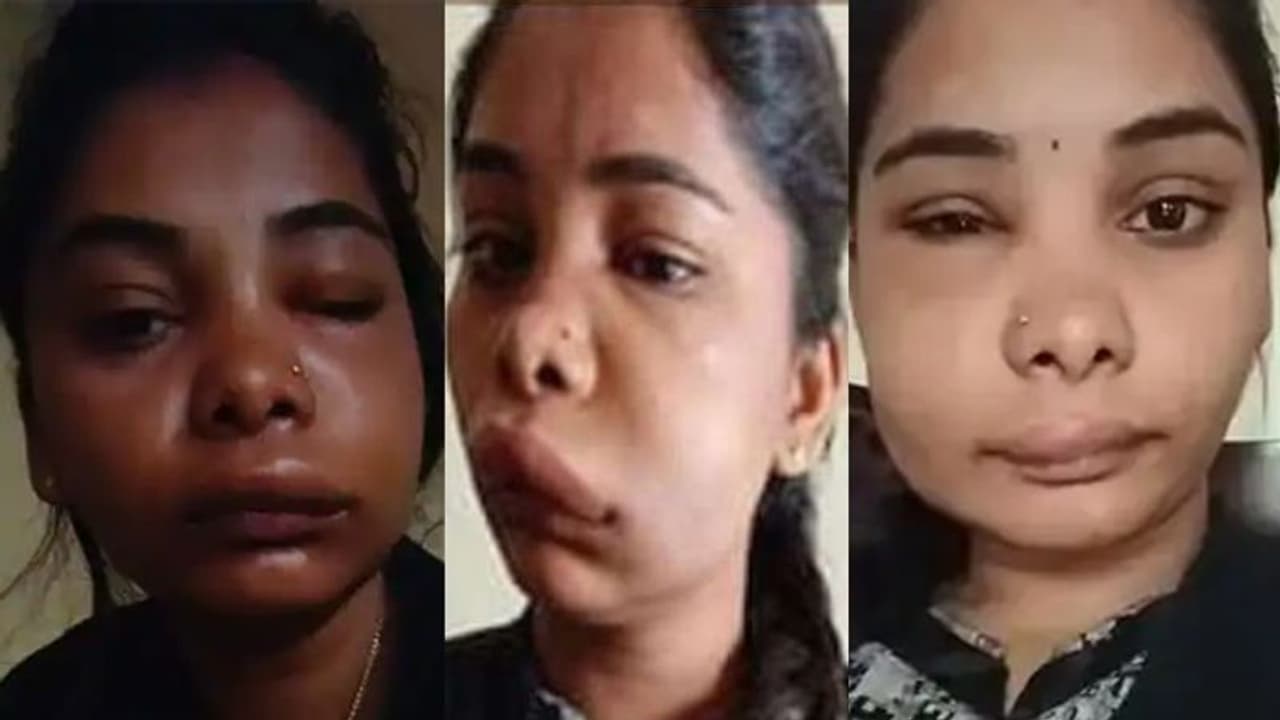 सर्जरी के बाद ऐसा बिगड़ा एक्ट्रेस का चेहरा कि पहचानना हुआ मुश्किल, अब घर से बाहर भी नहीं निकल रही सर्जरी के बाद ऐसा बिगड़ा एक्ट्रेस का चेहरा कि पहचानना हुआ मुश्किल, अब घर से बाहर भी नहीं निकल रही