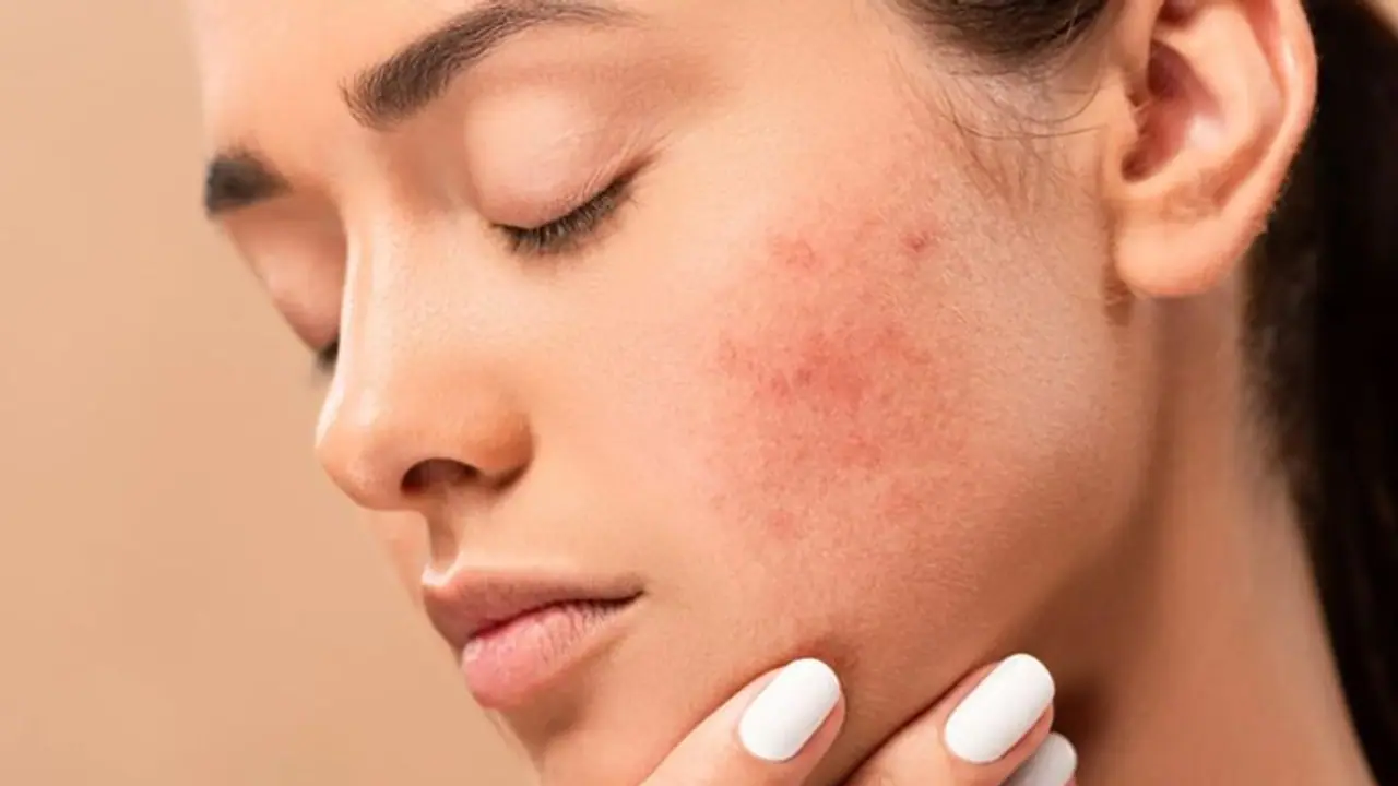 ഇവ ഉപയോ​ഗിച്ചാൽ മതി, മുഖക്കുരുവിന്റെ പാടുകൾ അകറ്റാൻ സഹായിക്കും 