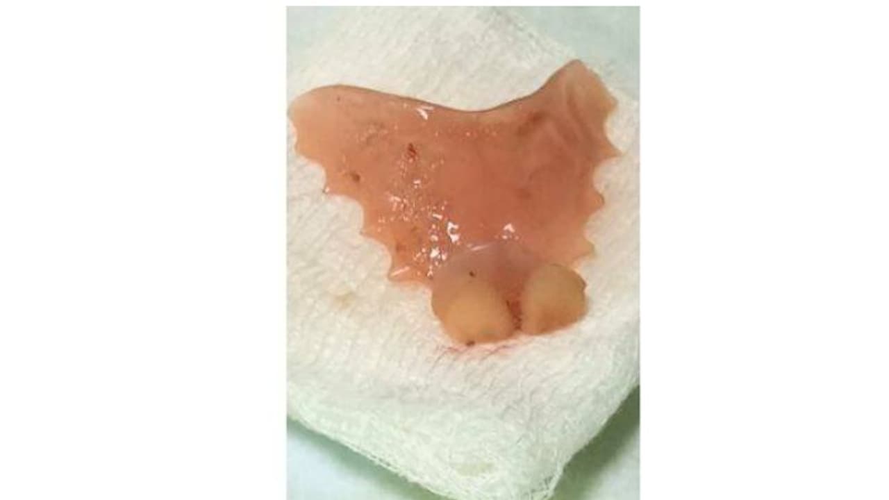 ഉറക്കത്തിൽ വെപ്പുപല്ല് തൊണ്ടയിലിറങ്ങി അന്നനാളത്തിൽ കുടുങ്ങി; ഒടുവിൽ എന്ഡോസ്കോപ്പിയിലൂടെ പുറത്തെടുത്തു ഉറക്കത്തിൽ വെപ്പുപല്ല് തൊണ്ടയിലിറങ്ങി അന്നനാളത്തിൽ കുടുങ്ങി; ഒടുവിൽ എന്ഡോസ്കോപ്പിയിലൂടെ പുറത്തെടുത്തു