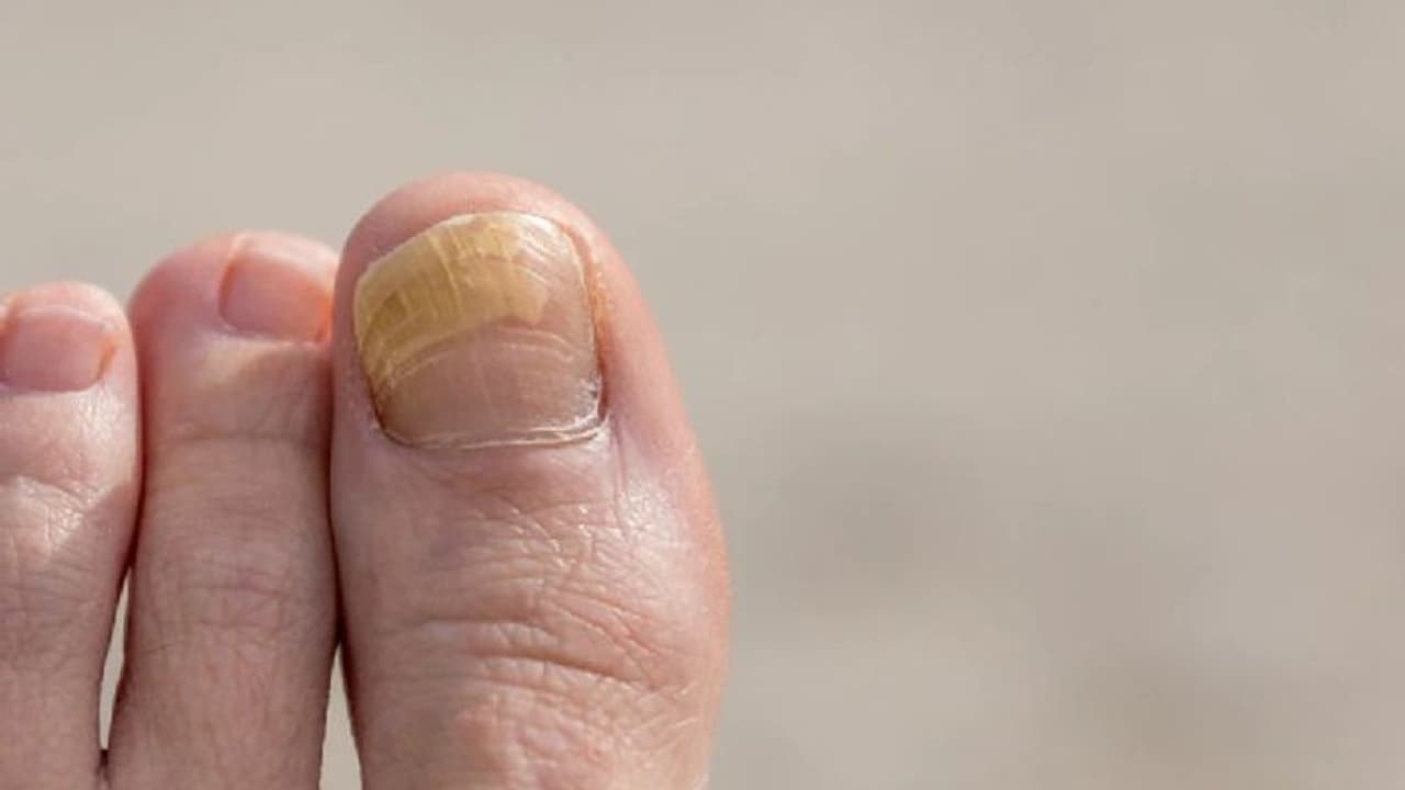 Nail Discoloration : കാല്‍നഖങ്ങള്‍ പൊട്ടുന്നതും നിറം മാറുന്നതും എന്തുകൊണ്ട്? 