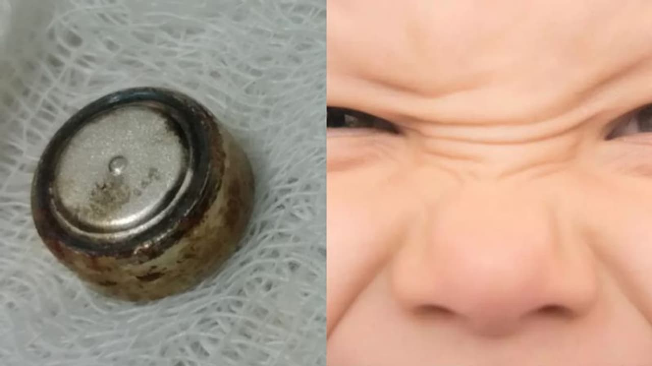 കളിക്കിടെ നാല് വയസുകാരൻ മൂക്കിൽ ബാറ്ററിയിട്ടു, ശ്വാസനാളത്തിൽ കുടുങ്ങി: വിദഗ്ധമായി പുറത്തെടുത്തു കളിക്കിടെ നാല് വയസുകാരൻ മൂക്കിൽ ബാറ്ററിയിട്ടു, ശ്വാസനാളത്തിൽ കുടുങ്ങി: വിദഗ്ധമായി പുറത്തെടുത്തു