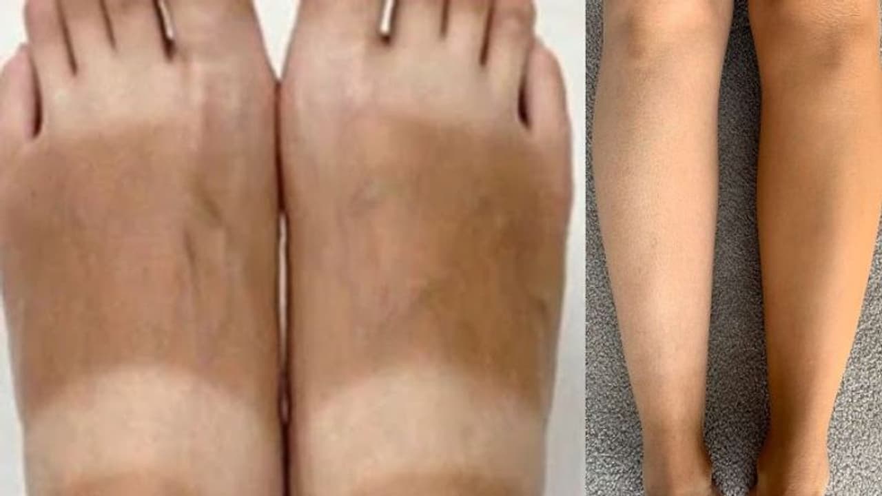 Skin Tan : സ്കിന്‍ ഇങ്ങനെയാകുന്നതില്‍ അസ്വസ്ഥതയോ? പരിഹാരമുണ്ട്...