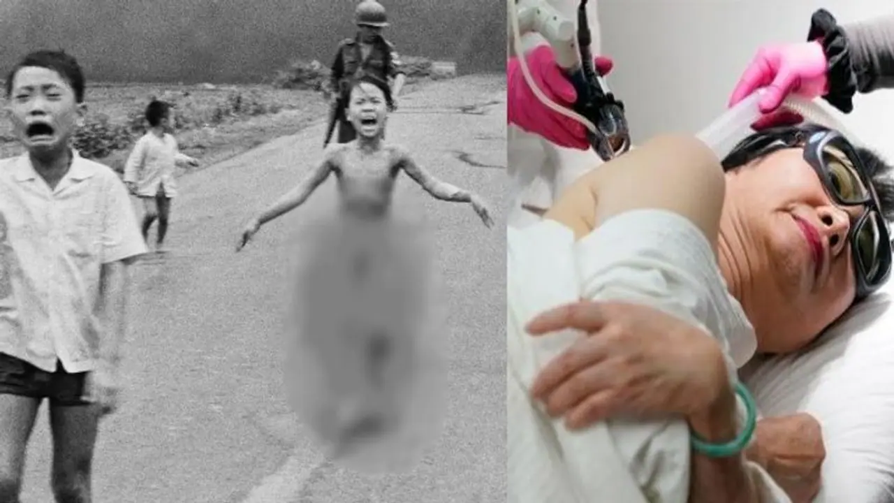 जान बचाने के लिए बिना कपड़ों के भागी इस लड़की ने बताई थी वियतनाम जंग की पीड़ा, 50 साल बाद हुआ अंतिम ऑपरेशन जान बचाने के लिए बिना कपड़ों के भागी इस लड़की ने बताई थी वियतनाम जंग की पीड़ा, 50 साल बाद हुआ अंतिम ऑपरेशन