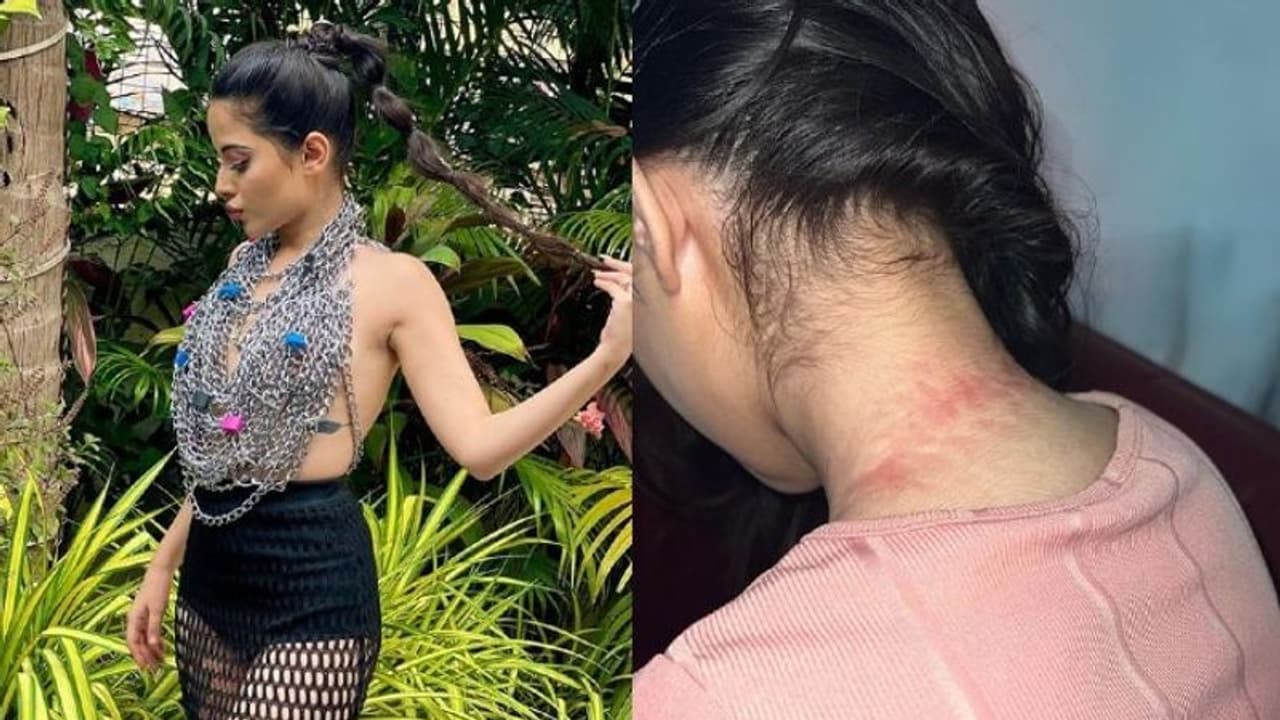 ചങ്ങല കൊണ്ടുള്ള ടോപ് ധരിച്ച് ഫോട്ടോഷൂട്ട്; കഴുത്തിന് പരുക്കേറ്റ ചിത്രം പങ്കുവച്ച് ബിഗ് ബോസ് താരം