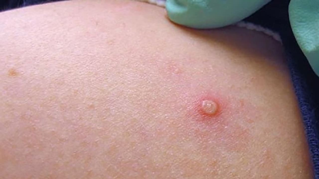 Monkeypox Disease : ജനേന്ദ്രിയത്തില്‍ കുമിളകള്‍, പനി; മങ്കിപോക്സിനെ കുറിച്ച് പുതിയ വിവരങ്ങള്‍