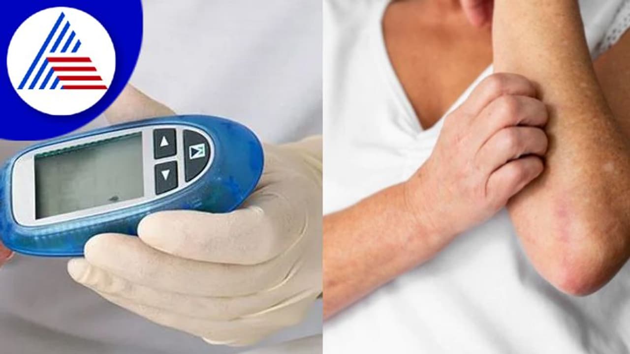 ಡಯಾಬಿಟಿಸ್ ಇರೋರು ಚರ್ಮದ ಬಗ್ಗೆಯೂ ಕಾಳಜಿ ವಹಿಸಿ