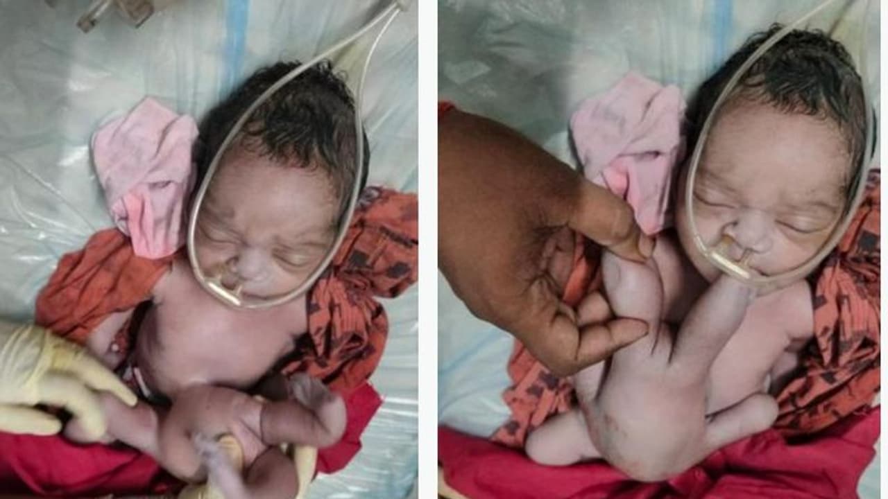 ನಾಲ್ಕು ಕೈ ಕಾಲುಗಳನ್ನು ಹೊಂದಿದ ವಿಚಿತ್ರ ಮಗು ಜನನ : ದೇವಿಯ ಅವತಾರವೆಂದ ಜನ