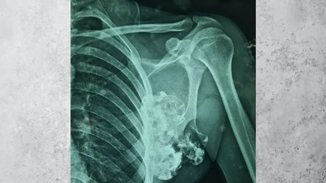 जयपुर के डॉक्टरों ने किया कमाल, कंधे की हड्डी से फूलगोभी की साइज का ट्यूमर निकाला...रिपोर्ट देख रह गए थे दंग जयपुर के डॉक्टरों ने किया कमाल, कंधे की हड्डी से फूलगोभी की साइज का ट्यूमर निकाला...रिपोर्ट देख रह गए थे दंग