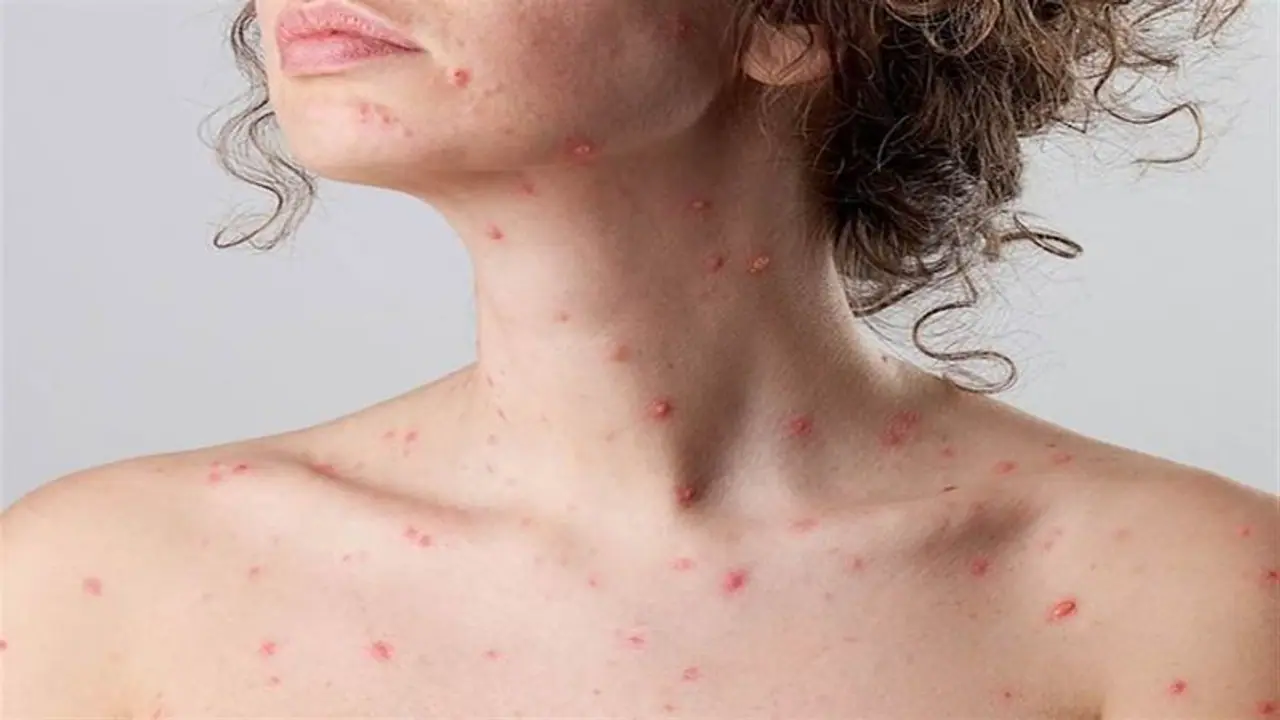 ত্বকে সামান্য ঘা দেখা দিলেও সতর্ক হন, দ্রুত বাড়ছে মাঙ্কিপক্সে সংক্রমণ ত্বকে সামান্য ঘা দেখা দিলেও সতর্ক হন, দ্রুত বাড়ছে মাঙ্কিপক্সে সংক্রমণ