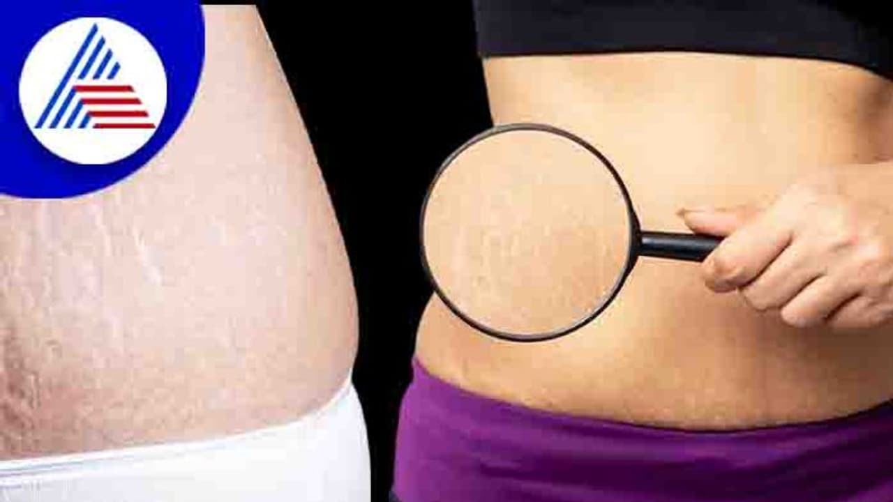 ಸ್ಟ್ರೆಚ್ ಮಾರ್ಕ್ ಬಗ್ಗೆ ಚಿಂತೆ ಬೇಡ, ಈ ಮನೆಮದ್ದು ಟ್ರೈ ಮಾಡಿ... ಸ್ಟ್ರೆಚ್ ಮಾರ್ಕ್ ಬಗ್ಗೆ ಚಿಂತೆ ಬೇಡ, ಈ ಮನೆಮದ್ದು ಟ್ರೈ ಮಾಡಿ...