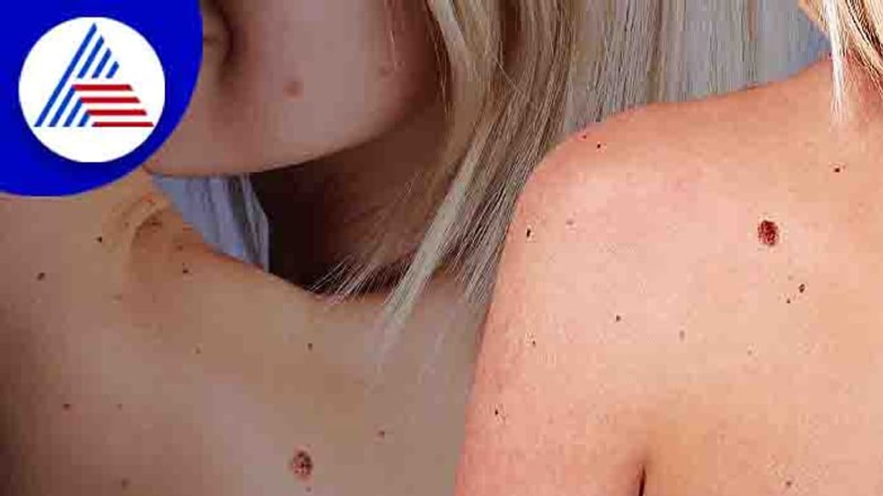 Skin Cancer: ನಿಮ್ಮ ದೇಹದ ಮೇಲೂ ಇಂತಹ ಮಚ್ಚೆಗಳಿವೆಯೇ? ಎಚ್ಚರವಿರಲಿ Skin Cancer: ನಿಮ್ಮ ದೇಹದ ಮೇಲೂ ಇಂತಹ ಮಚ್ಚೆಗಳಿವೆಯೇ? ಎಚ್ಚರವಿರಲಿ