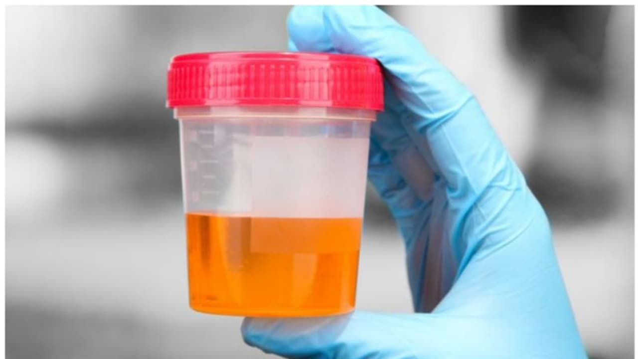 Urine Color : മൂത്രത്തിന്റെ നിറം പറയും നിങ്ങളുടെ ആരോഗ്യം Urine Color : മൂത്രത്തിന്റെ നിറം പറയും നിങ്ങളുടെ ആരോഗ്യം