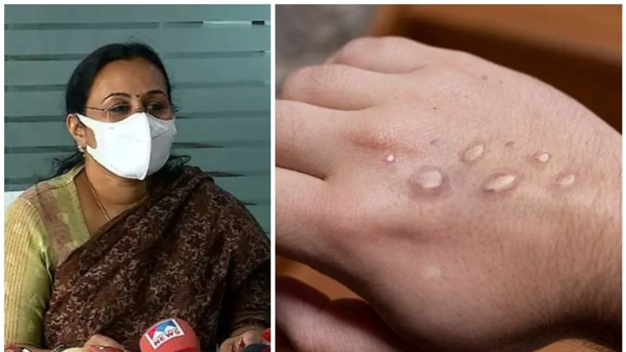 'രോഗി വിദേശത്ത് നിന്നെത്തിയത് മുൻ കരുതലുകൾ സ്വീകരിച്ച്, മങ്കി പോക്സിൽ ആശങ്ക വേണ്ട' : ആരോഗ്യ മന്ത്രി 'രോഗി വിദേശത്ത് നിന്നെത്തിയത് മുൻ കരുതലുകൾ സ്വീകരിച്ച്, മങ്കി പോക്സിൽ ആശങ്ക വേണ്ട' : ആരോഗ്യ മന്ത്രി