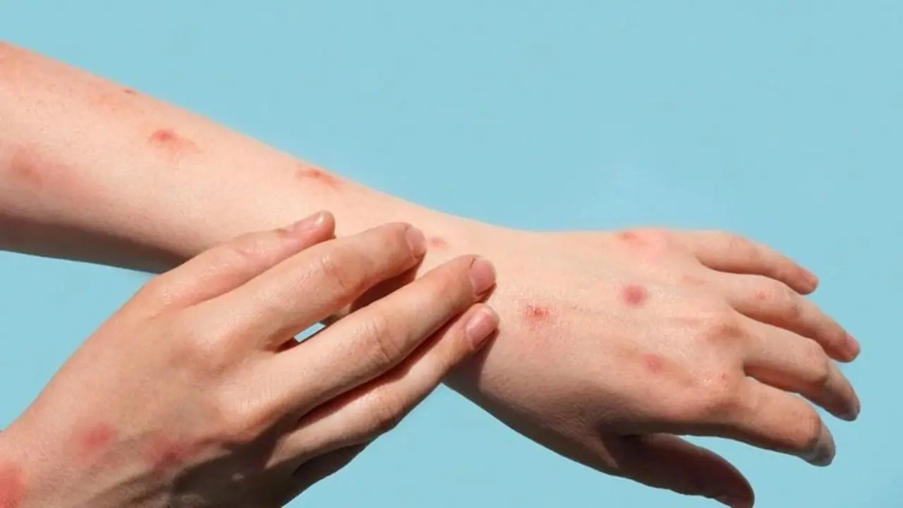 Task force set up to closely track monkeypox virus in India