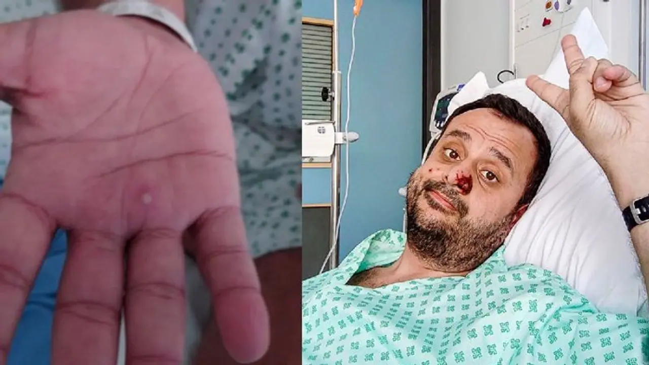 Monkeypox Experience : മങ്കിപോക്സ് അനുഭവം തുറന്നുപറഞ്ഞ് ലൈംഗികാരോഗ്യ മേഖലയില്‍ പ്രവര്‍ത്തിക്കുന്നയാള്‍