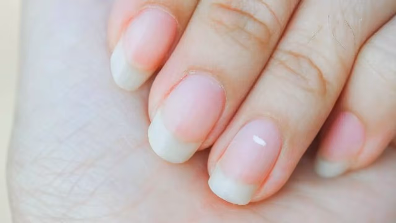 നഖങ്ങളില്‍ വെളുത്ത നിറത്തിലുളള കുത്തുകള്‍ കാണുന്നത് എന്തുകൊണ്ട്?