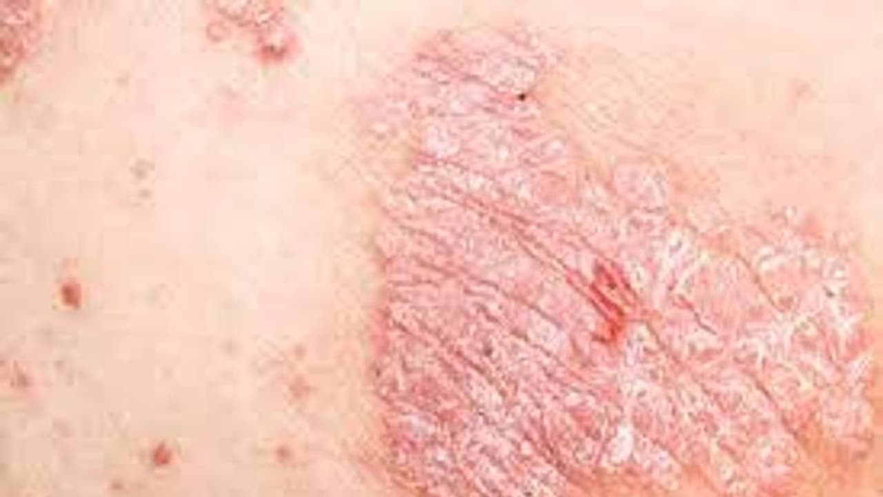 World Psoriasis Day 2022 : ചർമ്മത്തെ ബാധിക്കുന്ന സങ്കീർണമായ അസുഖം; സോറിയാസിസിന്റെ ലക്ഷണങ്ങൾ എന്തൊക്കെ?