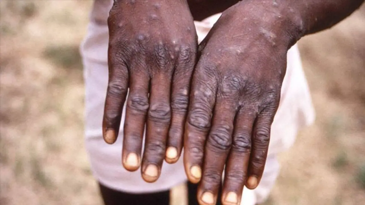 Monkeypox : മങ്കിപോക്സ് ; ഇവർക്ക് രോ​ഗം പിടിപ്പെട്ടാൽ സങ്കീർണതകൾ കൂടുതൽ ആകാൻ സാധ്യത : പഠനം