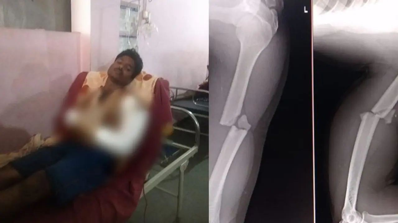 ಬೆಳಗಾವಿ: ಕಾಡುಕೋಣ ಹಿಡಿಯಲು ಹೋಗಿ ಕೈ ಮೂಳೆ ಕಟ್: ತುತ್ತು ಅನ್ನಕ್ಕಾಗಿ ಅರಣ್ಯ ಇಲಾಖೆ ನೌಕರ ಪರದಾಟ