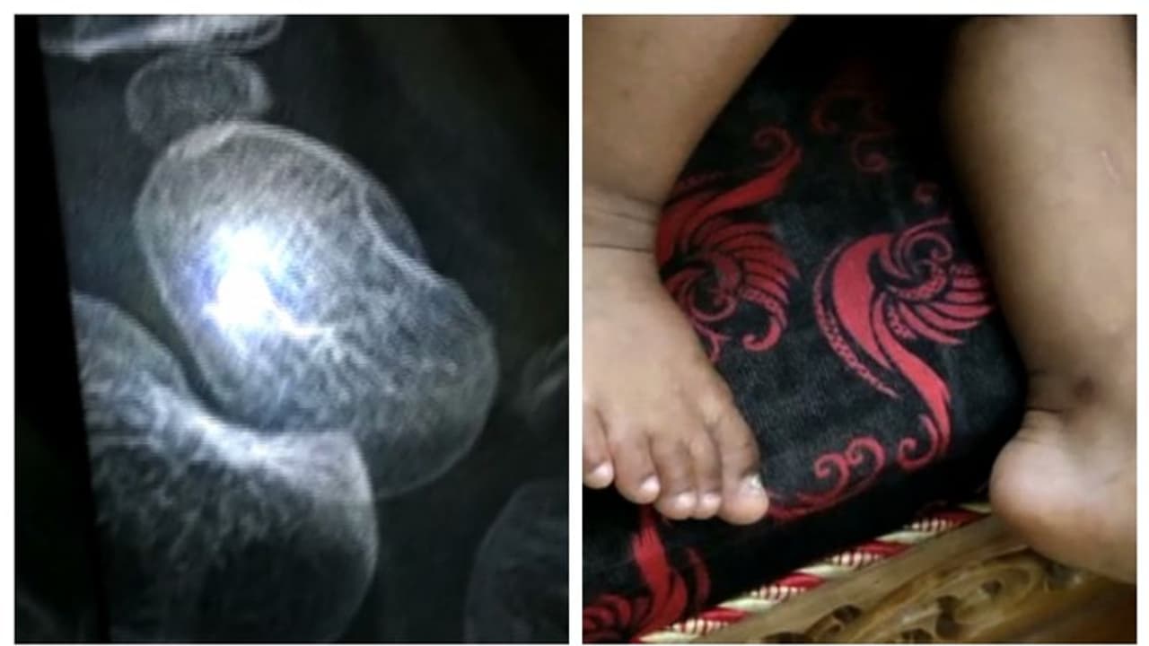 ഡ്രിപ്പ് ഇടാന് കുത്തിയ സൂചി കുഞ്ഞിന്റെ കാലില് ഒടിഞ്ഞ് തറച്ചു, ശസ്ത്രക്രിയ നടത്തി സൂചി പുറത്തെടുത്തു ഡ്രിപ്പ് ഇടാന് കുത്തിയ സൂചി കുഞ്ഞിന്റെ കാലില് ഒടിഞ്ഞ് തറച്ചു, ശസ്ത്രക്രിയ നടത്തി സൂചി പുറത്തെടുത്തു